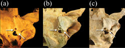 Figure 9. Posteroventral view of the basicranium and left bulla in a Monachus monachus b Neomonachus schauinslandi, and c Neomonachus tropicalis. The bulla of Monachus is bordered posteriorly by a ventrally expanded posterior portion of the petro-mastoid complex. The petrosal abuts the bulla’s posterior wall and in ventral view forms the entire lateral and anterolateral border of the posterior lacerate foramen. In Neomonachus, the posterior part of the petrosal is visible in the posterior lacerate foramen but remains superior to the bulla. In ventral view, this gives the impression that the anterior border of the posterior lacerate foramen is formed entirely by the bulla. The posterior carotid canal opens posteroventrally in Monachus. This apparently results from a relatively complete “ring-like” opening, formed by the bulla. This form of opening is apparent in subadult and juvenile Monachus, suggesting that it is not dependent on ontogenetic development or the robusticity of the Monachus cranium relative to Neomonachus. In contrast, the posterior carotid canal of Neomonachus opens directly posteriorly, the opening being an incomplete ring and the dorsal border formed by a flattening of the bulla, perhaps resulting from the bulla’s extension over the petrosal.
